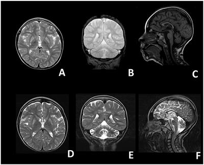 Clinical and Biochemical Features in a Patient With Mitochondrial Fission Factor Gene Alteration